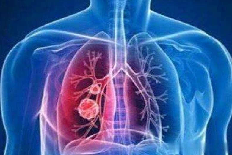 最新型冠状肺炎情况综述