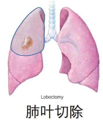 肺结节最新手术标准论述详解