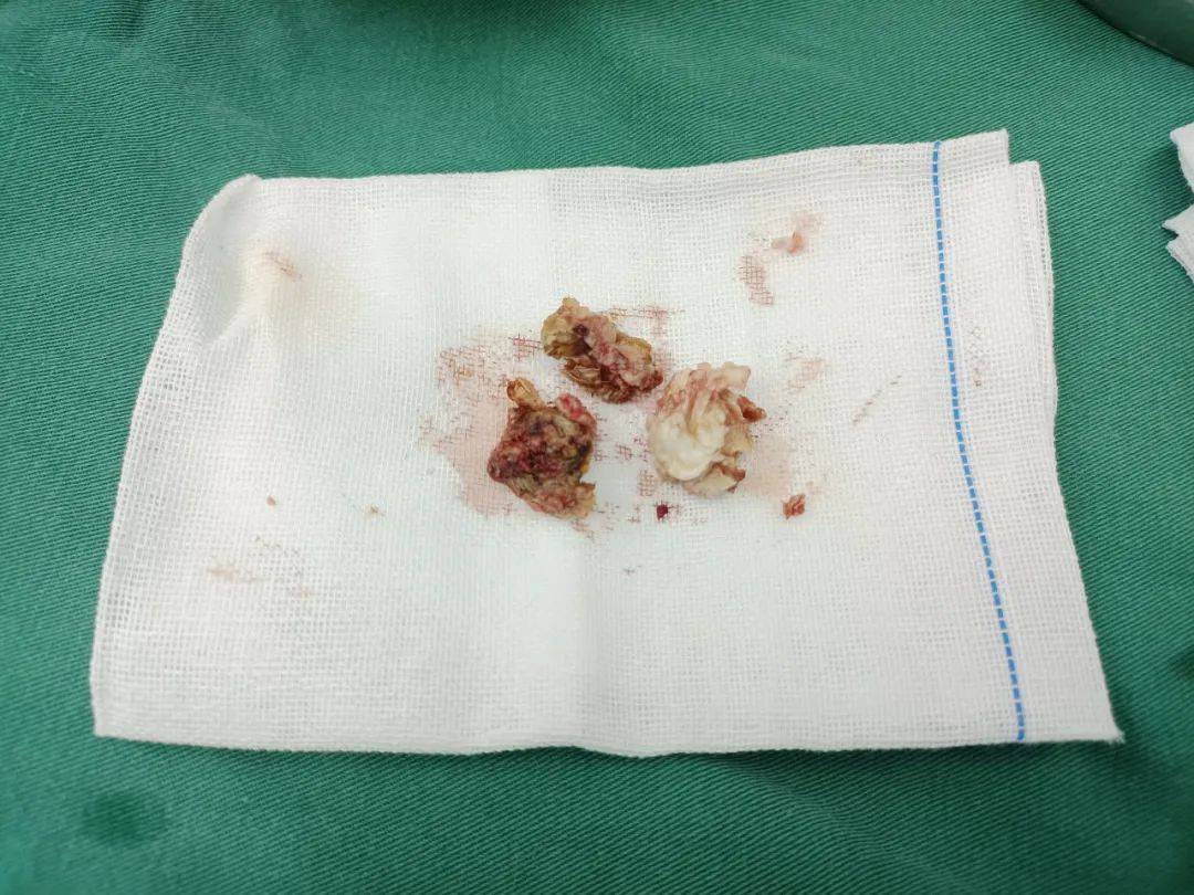 最新胆脂瘤手术价格揭秘，小巷深处的医疗宝藏探索