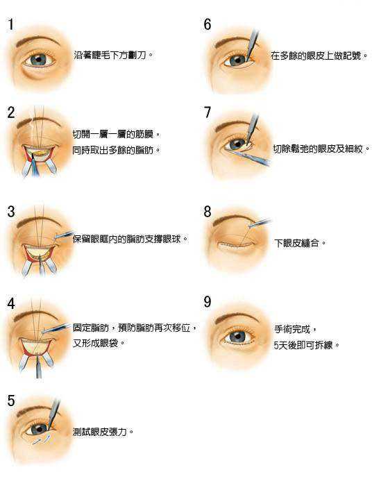 眼部整形最新技术揭秘