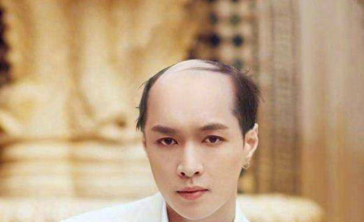 秃顶明星大盘点，这些明星竟然也遭遇了秃顶困境